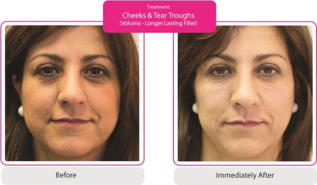 Before and After fillers