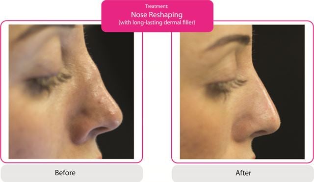 Nose Reshaping Fillers