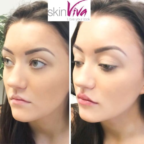 before-and-after-lip-filler before-and-after-lip-filler