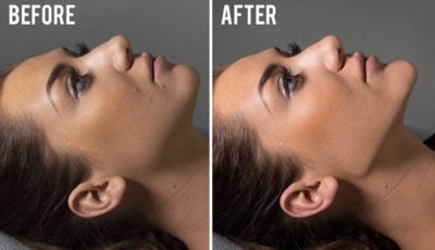 jawline bad result