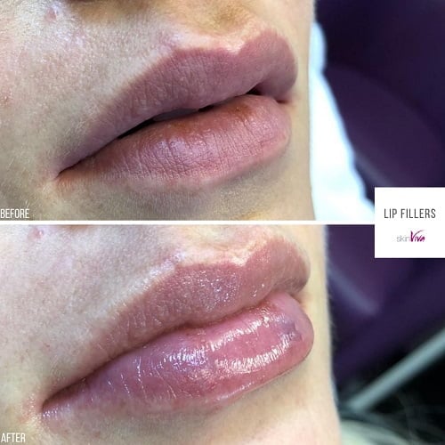 lip fillers hydrating 