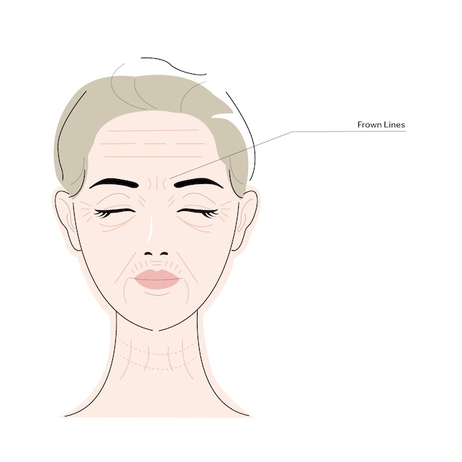 frown lines illustration