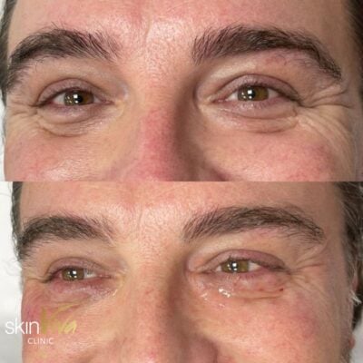 before after polynucleotides eyes male