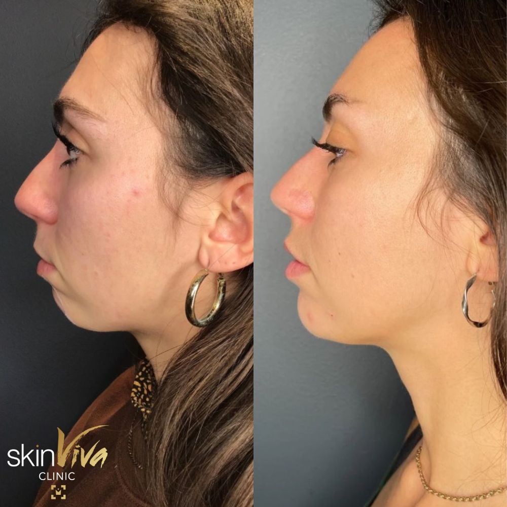 chin enhancement filler before after