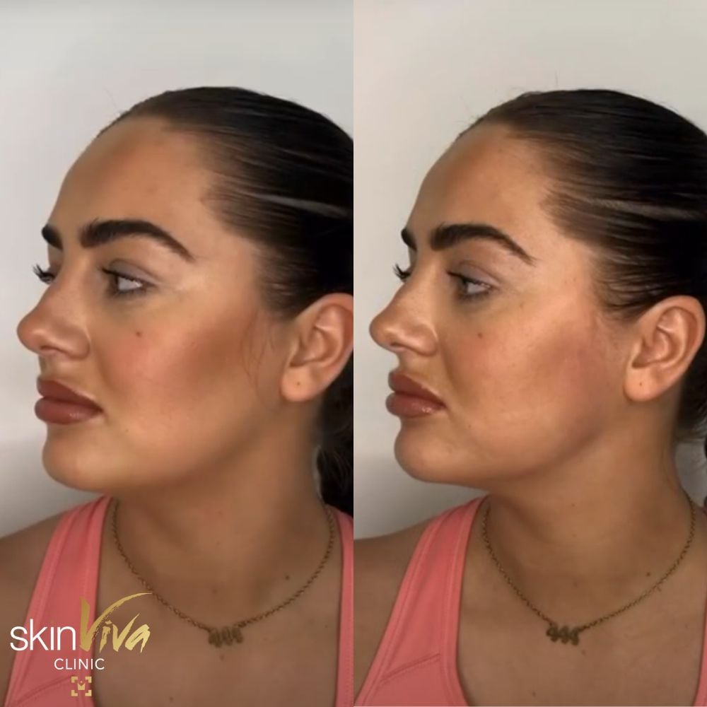 jowls & jawline results